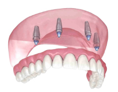 Dental implants in Marshall, Texas
