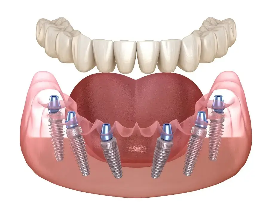 Dental implants in Marshall, Texas