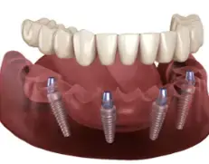 Dental implants in Marshall, Texas
