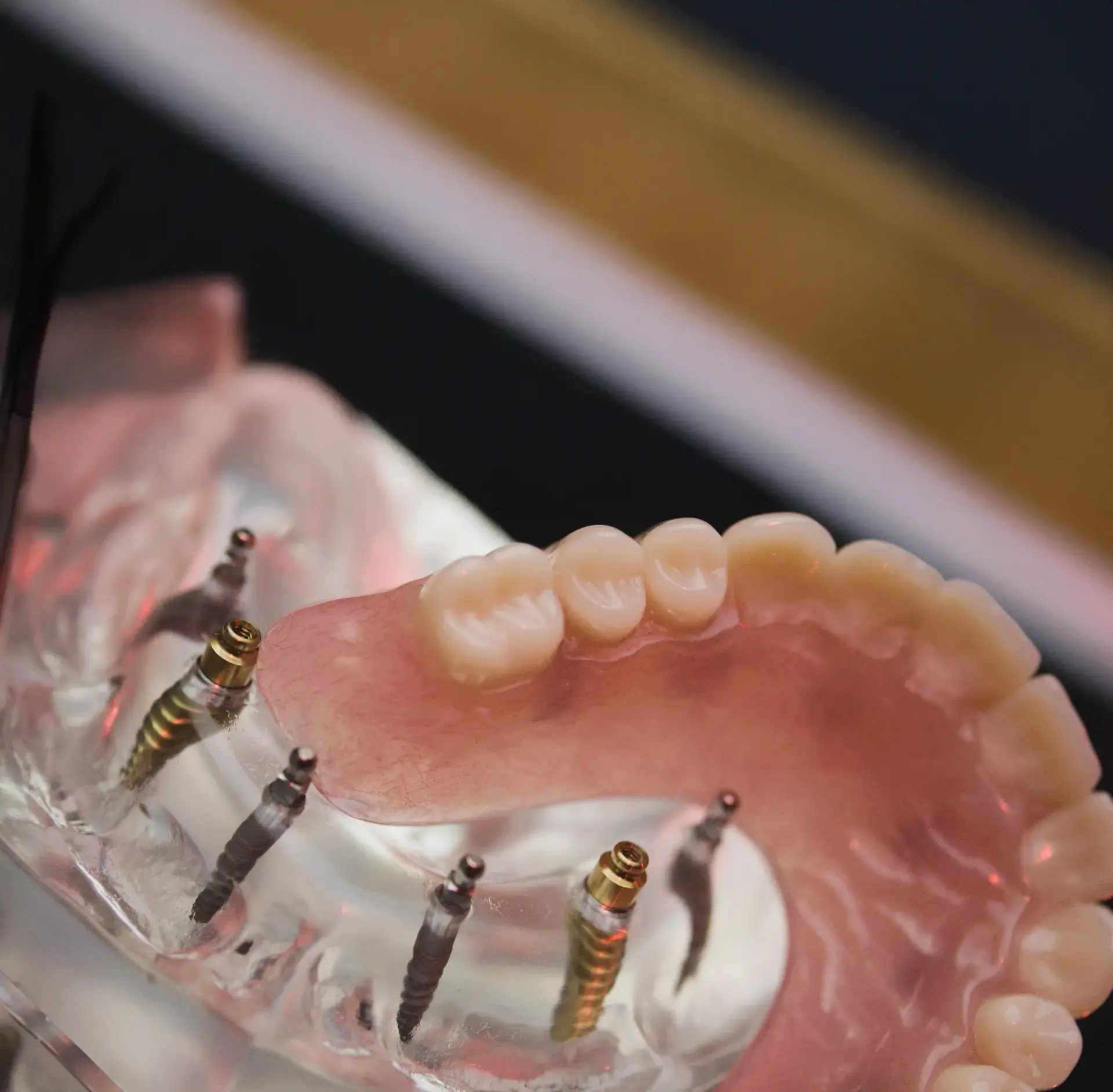 Full arch dental implants in Marshall, Texas - Choice Dental Dental implants in Marshall, Texas